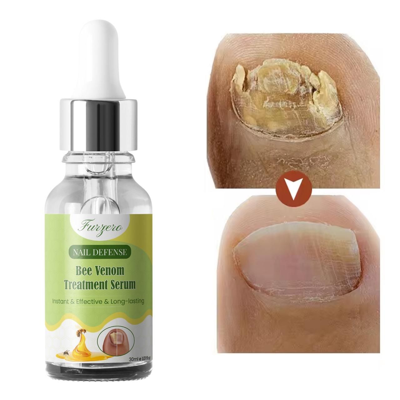 Furgero Nail Defense Bee Venom Treatment Serum – Strengthening & Repairing Formula | Pack of 1 / Pack of 2